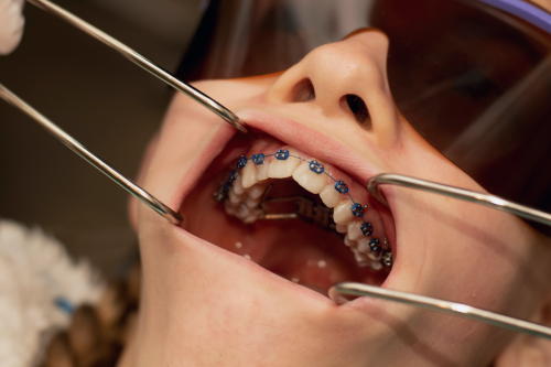 Open mouth held by cheek retractors, showing braces with blue ties on the upper teeth and a metal appliance behind them